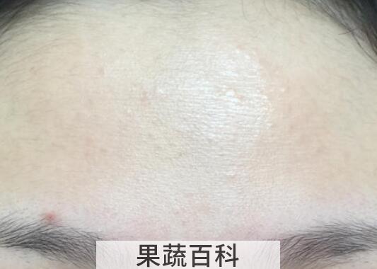 粉刺怎么消除 粉刺去除小妙招