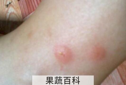 蚊子咬了怎么消肿止痒最快