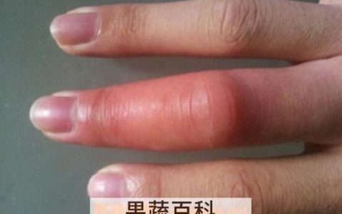 被蜜蜂蛰了怎么消肿快 蜜蜂蛰消肿的最快方法