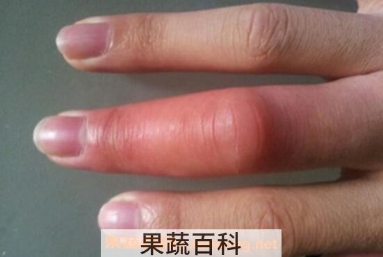 被蜜蜂蛰了怎么消肿快 蜜蜂蛰消肿的最快方法