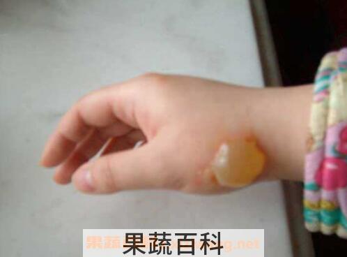 被油烫伤后怎么处理 油烫伤后的处理方法