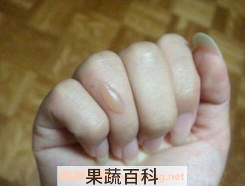 被油烫伤怎么办 被油溅到了皮肤小妙招