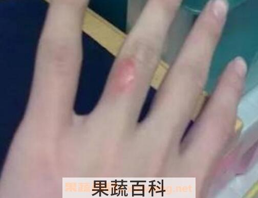 油烫伤起泡后怎么处理 被油烫伤怎么去疤