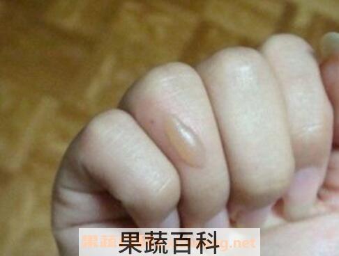 油烫伤起泡后怎么处理 被油烫伤怎么去疤
